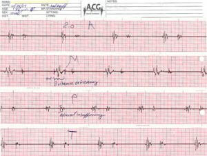 the acoustic cardiograph (ACG)